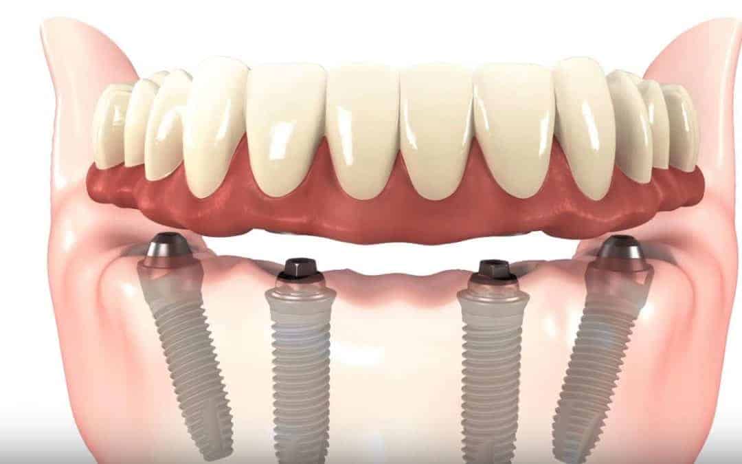 dental implants near you