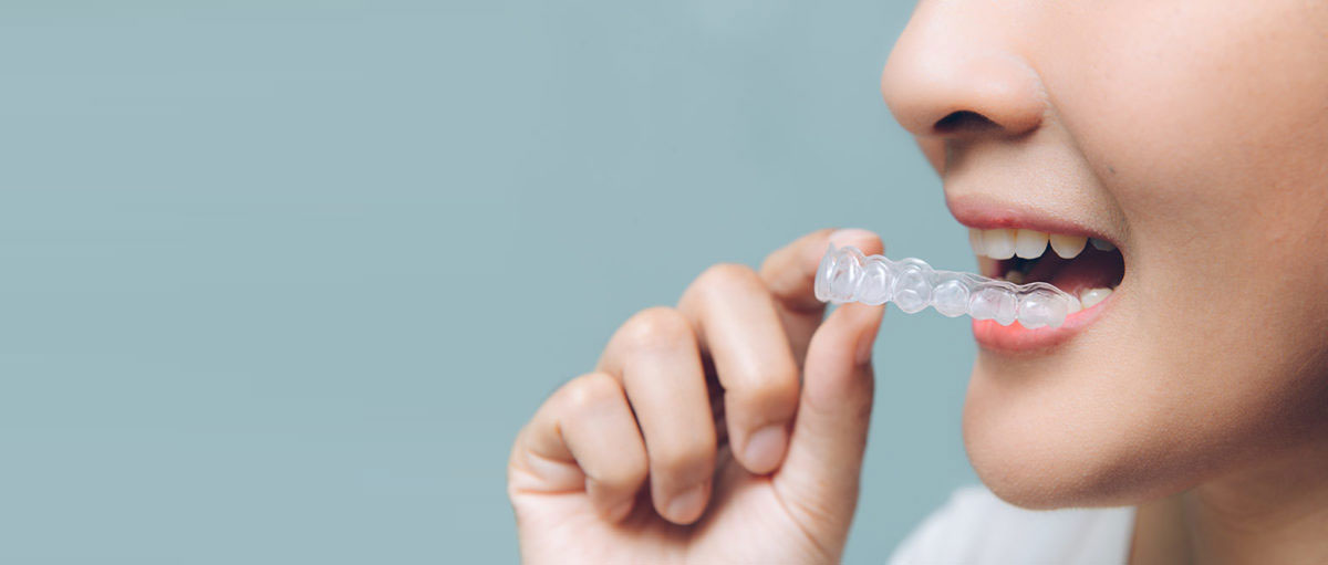 invisalign your braces free solution for straight smiles