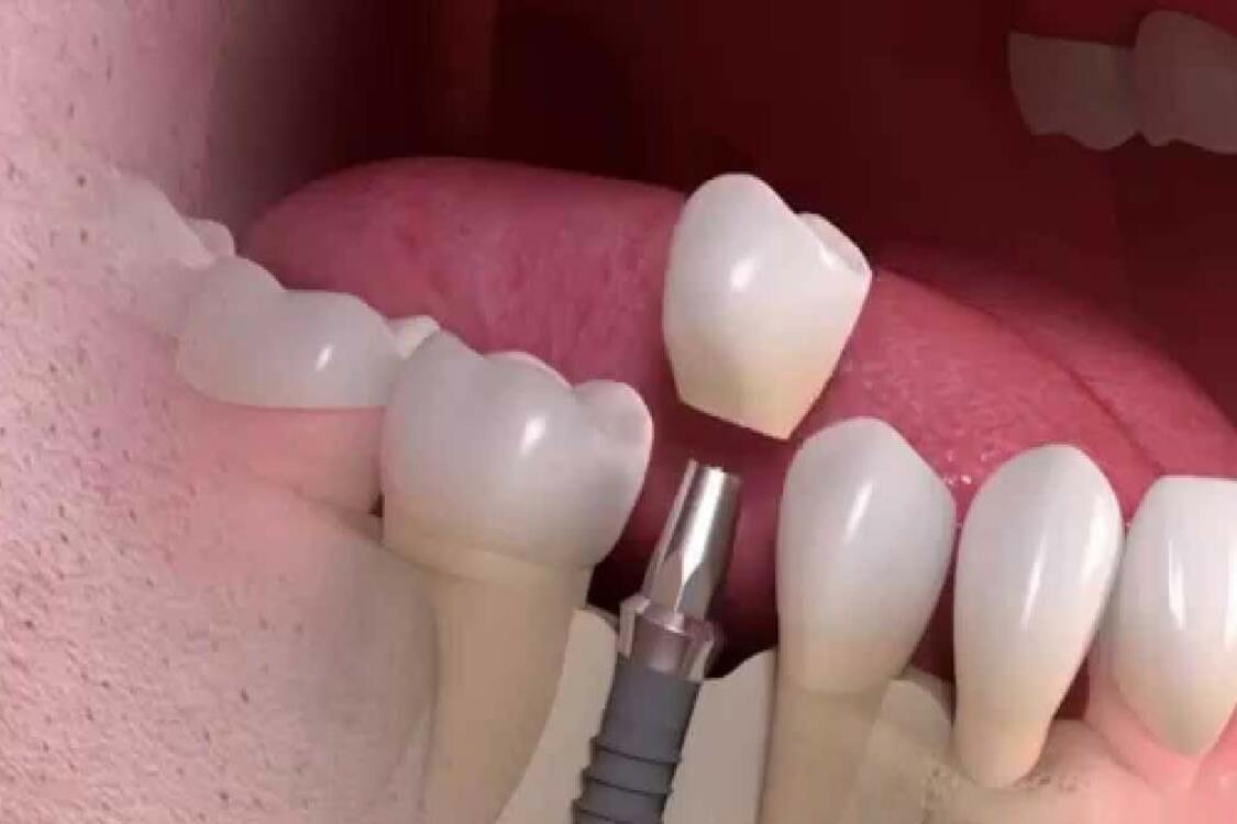 reduce your risk of infection after dental implants