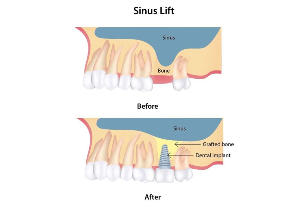 Sinus Lift Surgery
