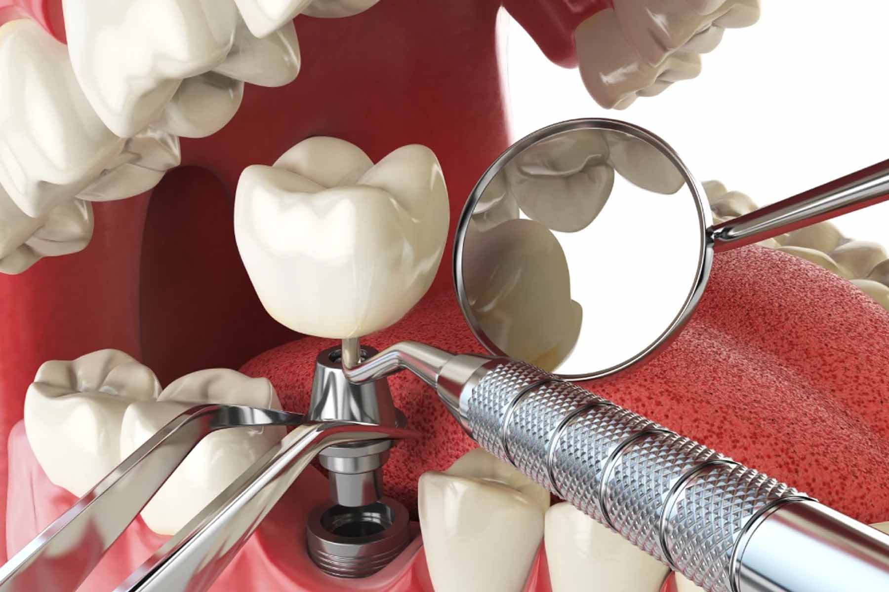 What are the benefits of dental implants?