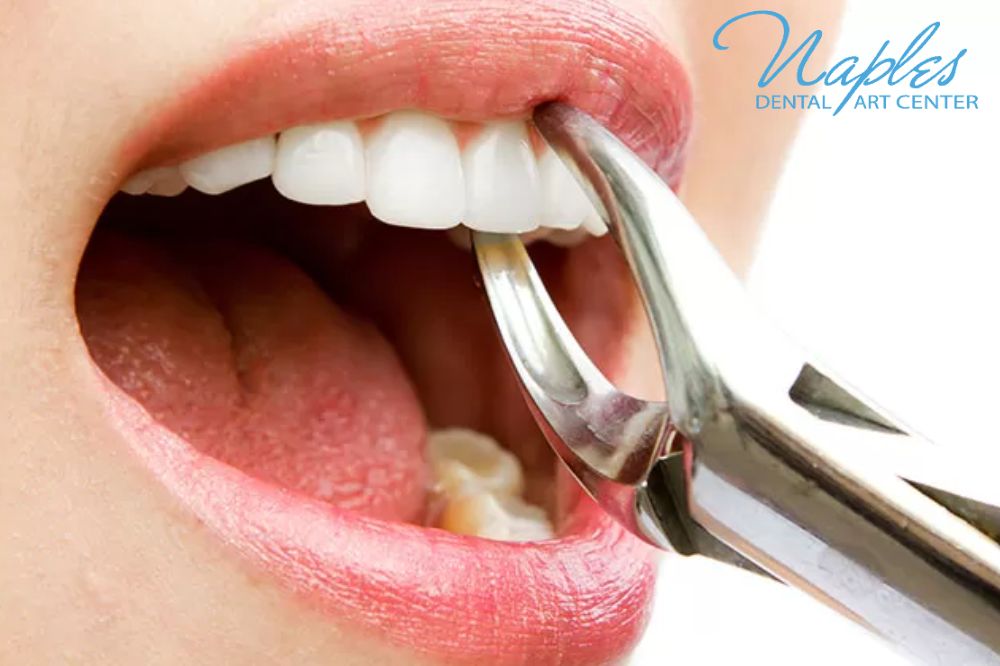 How to Manage Pain After Tooth Extraction