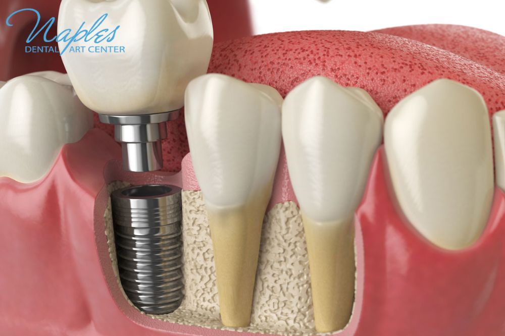 What is the downside to dental implants