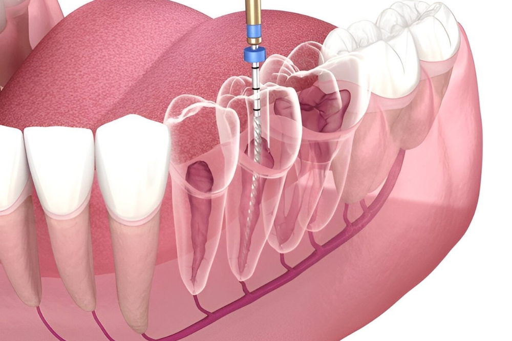 Wondering How Root Canal Therapy Really Works?