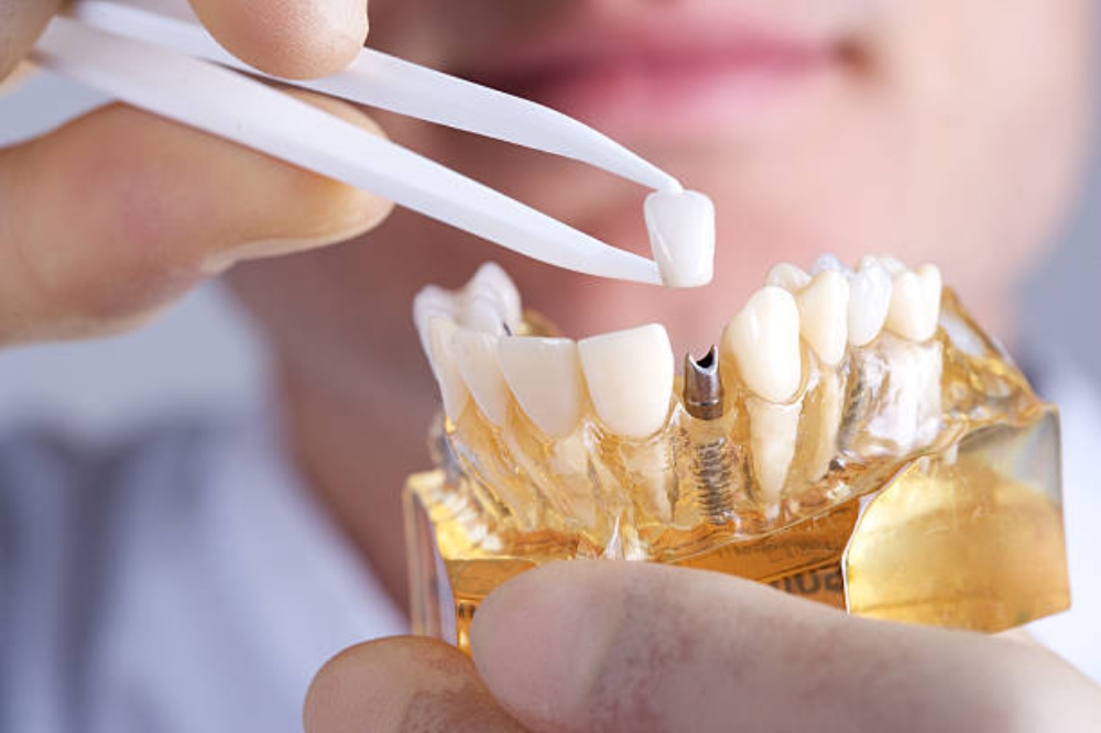 Dental Implant Explained: From Consultation to Final Crown