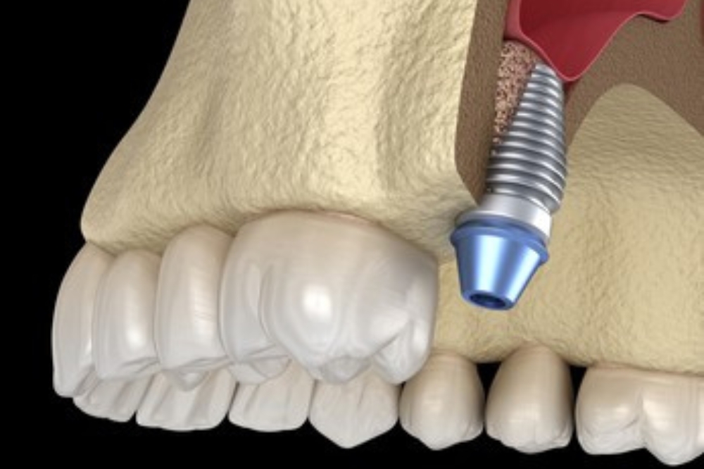 Sinus Lift Surgery Explained: Why It’s Done Before Dental Implants