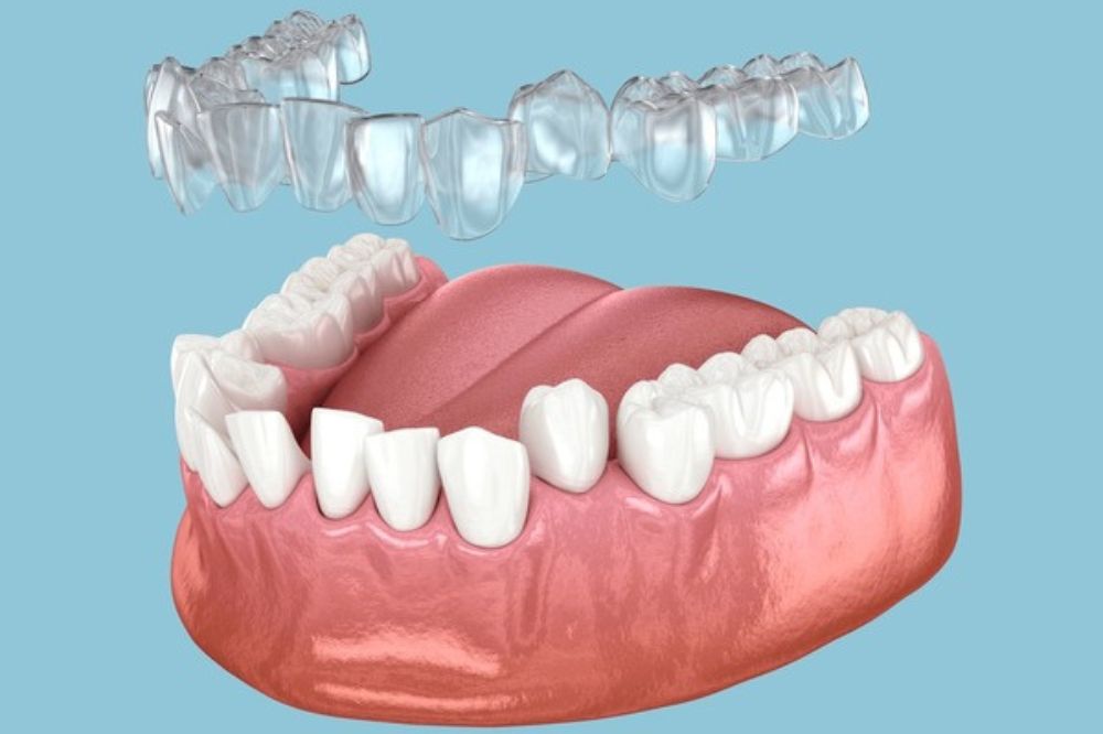 Want Straighter Teeth Without Metal Braces? How Invisalign Fits Your Lifestyle Today