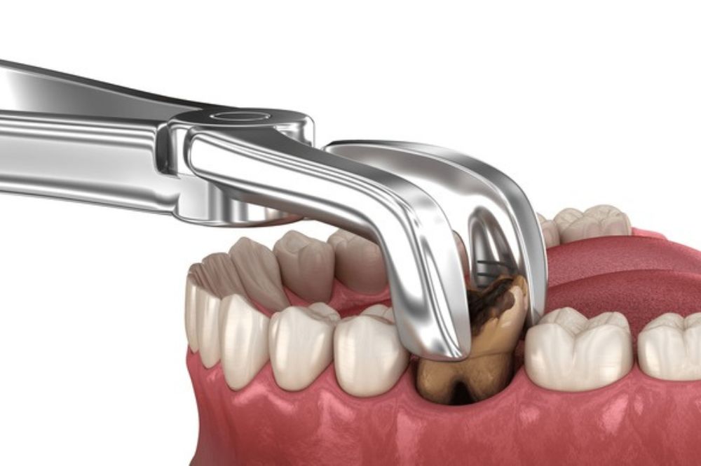 Is Tooth Extraction Painful Today? What Modern Dentistry Feels Like